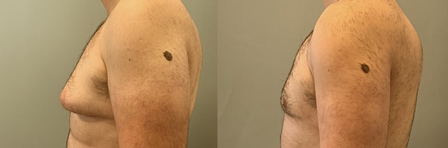 Гинекомастия Гинекомастия