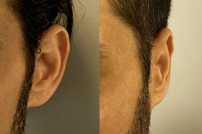 Ear pinning surgery